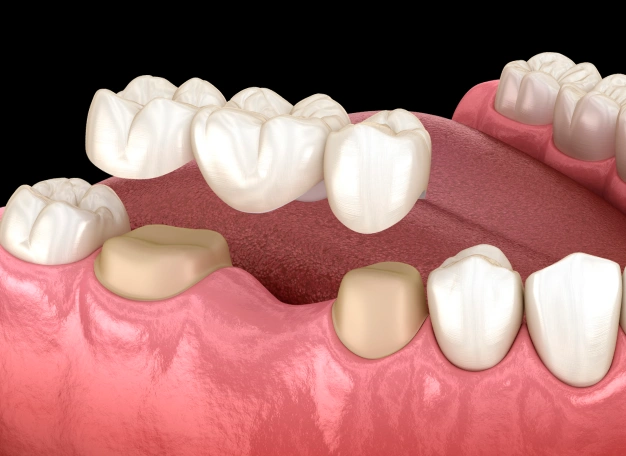 dental bridges in houston