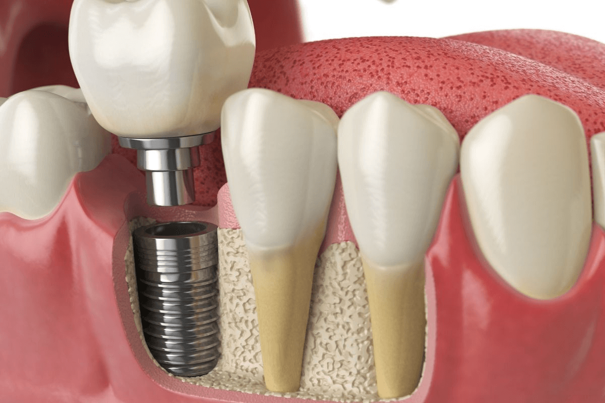 Dental Implant Procedure