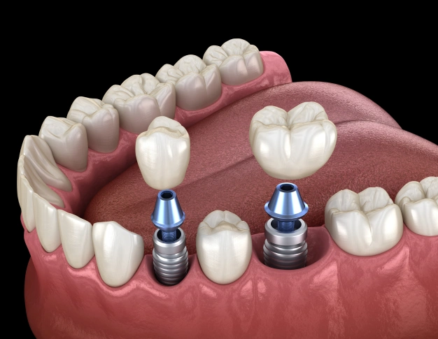 dental implant restorations in houston