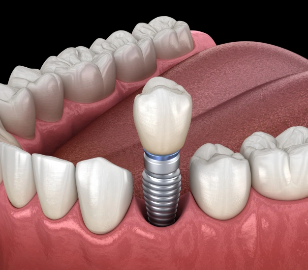 dental implants in houston