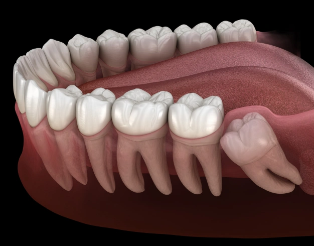 wisdom teeth removal in houston